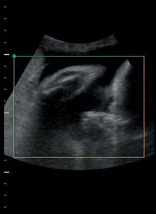 ultrasound